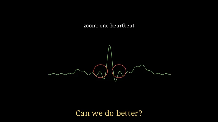 A single heartbeat after a brick-wall filter with ringing circled in red
